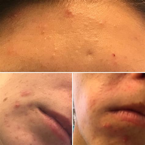 Is This Fungal Acne Have Tried Everything Please Help Routine In