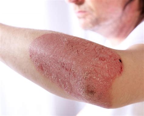 What Is Psoriasis With Pictures