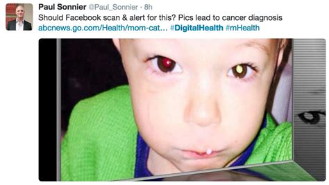 Cellphone Photo Revealed Toddlers Eye Cancer