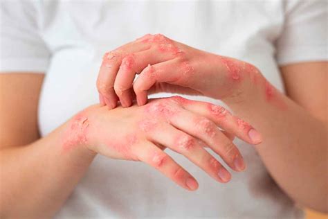 Effective Eczema Treatments Consultation With London Dermatology Experts