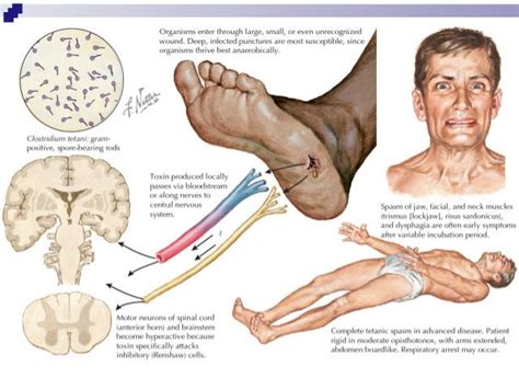 MED STUDENT : Tetanus