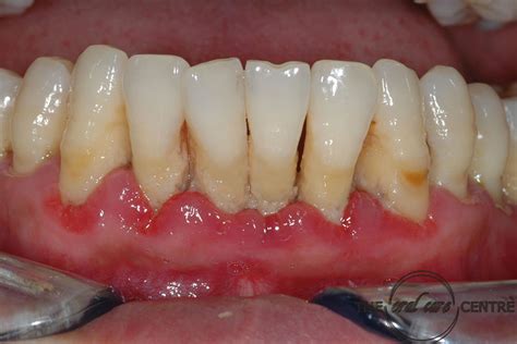 Signs Of Gum Disease Oralcare