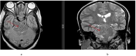 Figure 2 From Imaging Findings Of Head And Neck And Intracranial Sinus