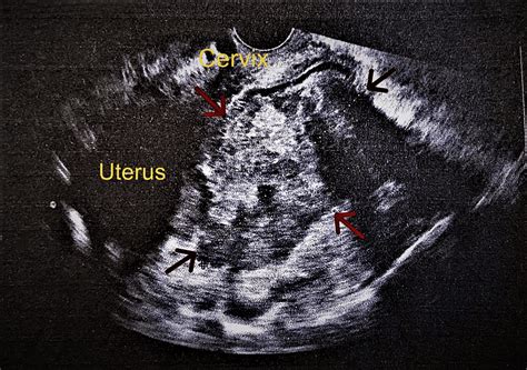 Cureus Adnexal Torsion Of A Mature Cystic Ovarian Teratoma With