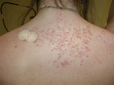 Prurigo Pigmentosa Causes Symptoms Diagnosis And Treatment