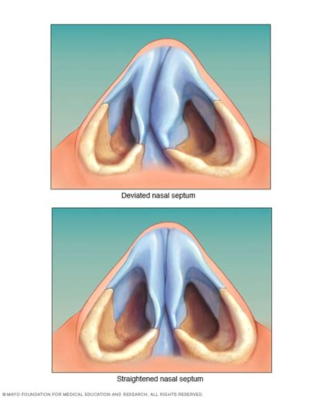 Deviated Septum Mayo Clinic