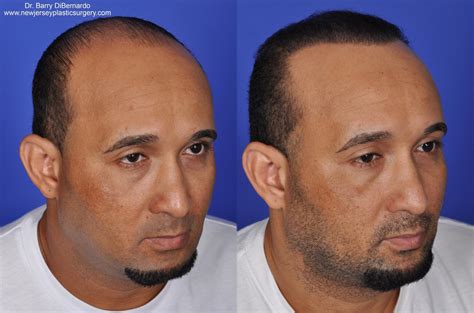 Hair Transplants Before And After