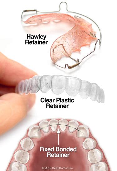 The Importance Of Retainers Myers Orthodontics