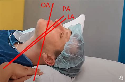Optimal Patient Positioning For Intubation And Airway Management The