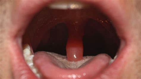 What Happens If Your Uvula Is Touching Your Tongue