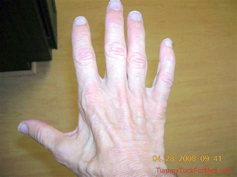 Ulnar Nerve Damage Caused Muscle Atrophy In Hand Ulnar Nerve Damage