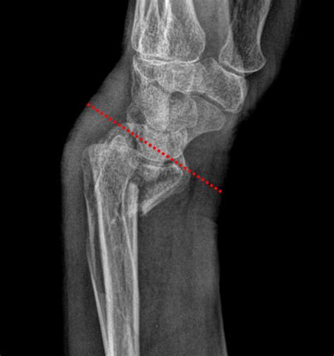 Smith Fracture Frykman Iv