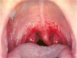 Images of Itchy Tongue And Roof Of Mouth