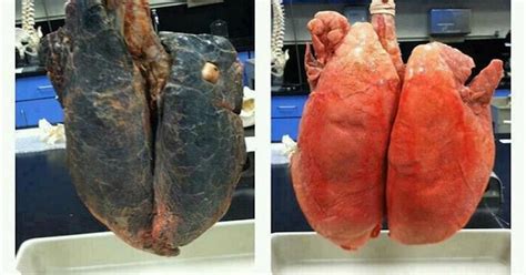 Lung cancer is the no. The Difference Between a Healthy and a Cancerous Lung