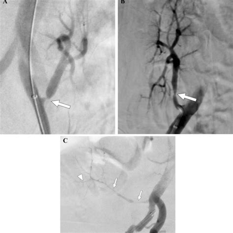 Transplant Renal Artery Stenosis Seen In Different Locations A