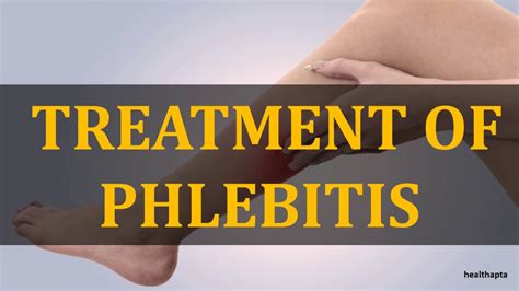 Treatment Of Phlebitis Youtube