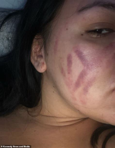 Woman Who Used A Katie Price Endorsed Blackhead Vacuum Says She Got
