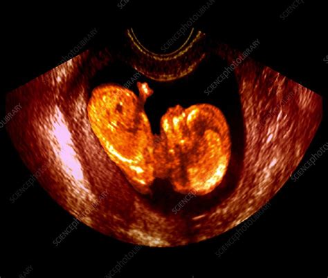 37 Week Foetus Ultrasound Scan Stock Image P6800569 Science