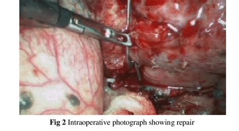 Intraoperative Photograph Showing Transected Thoracic Duct With Ongoing