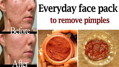 Everyday Face Pack To Remove Pimples Acne Dark Spots Scars Red