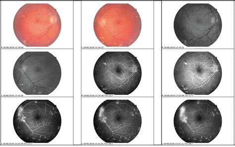 Scielo Brasil Retinal Ischemia As The First Manifestation Of
