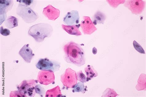 Abnormal Squamous Epithelial Cells View In Microscopy Hpv Criteria For Pap Smear Slide Cytology