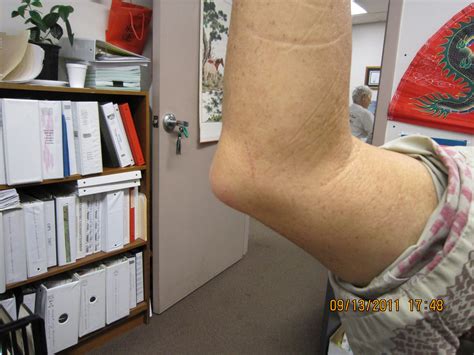 Right Elbow Huge Soft Lump With Bone Seeming To Protrude