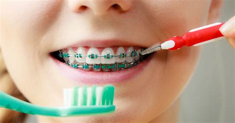 Teeth braces or a retainer are not something just for children's teeth, as many adults find the need to wear such devices. Advice from a Braces Dentist: How to Take Care of Braces