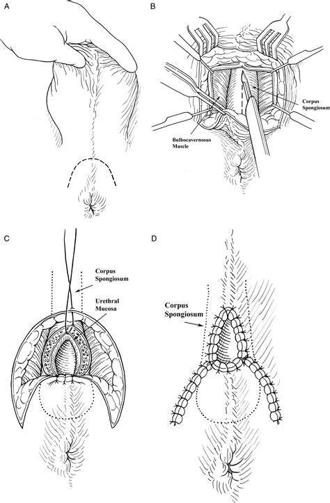 Methods the medical records of 59 cats that had undergone perineal urethrostomy were evaluated. The Outcomes of Perineal Urethrostomy With Preservation of ...