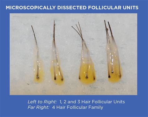 Follicular Unit Transfer Gl Perrault Md Hair Loss And Hair Restoration