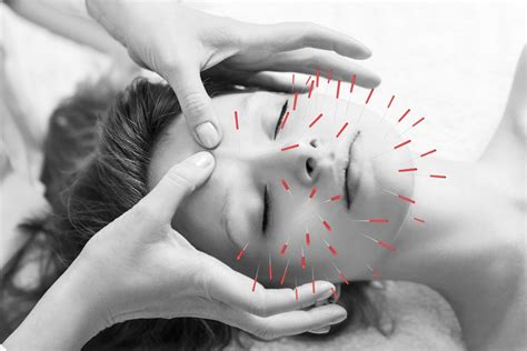 Can Acupuncture Help With Migraines National Headache Institute
