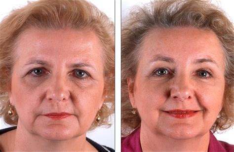 Highly rated brow lift clinics in mexico. Brow lift surgery video hysterectomy, breast reduction ...