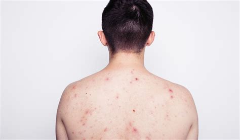 Banish Bacne—how To Get Rid Of Back Acne And Tiege Hanley