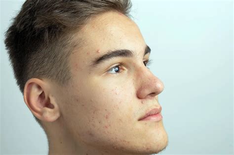 Teenage Acne May Be A Natural Transient Inflammatory State