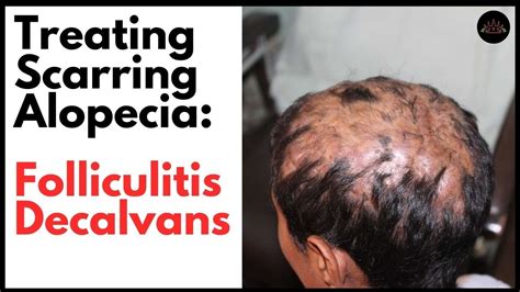 What Is Folliculitis Decalvans And How Can It Be Treated Youtube