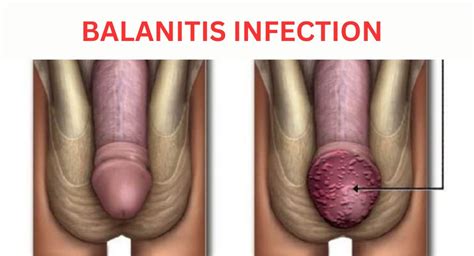Balanitis Symptoms Causes Testing And Treatment