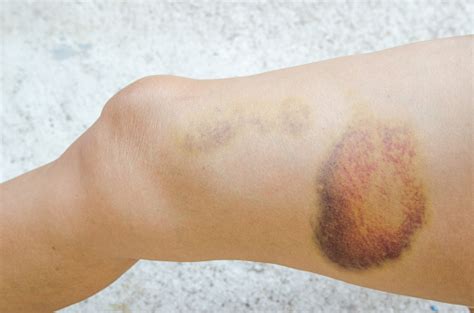 Large Bruise On Human Leg Injection Bruises Doctor And Patient Stock
