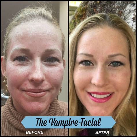 Vampire Facelift Vs Vampire Facial Whats The Difference Beverly