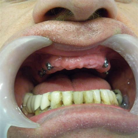 Dental Implant Casesathens Dental Dimitris Antoniou