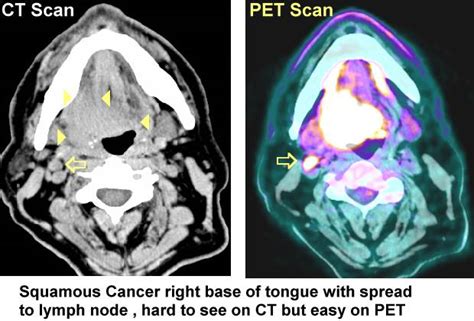 Pet And Ct Scans