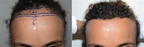 Hair Transplant Recovery Time Fue Recovery Timeline