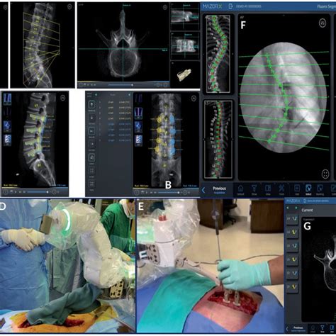 Pdf Robotic Spine Surgery A Review Of The Present Status