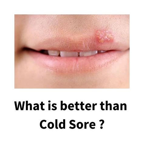 Cold Sores Vs Canker Sores Infographic Images