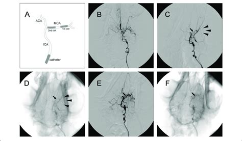 Representative Digital Subtraction Angiography DSA Images Of Download Scientific Diagram