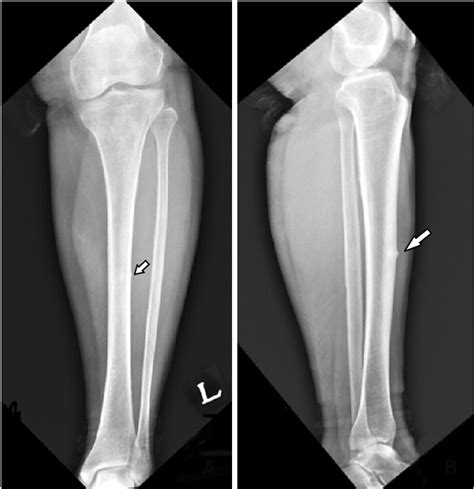 Preoperative Radiograph Shows Atypical Tibial Diaphyseal Fracture