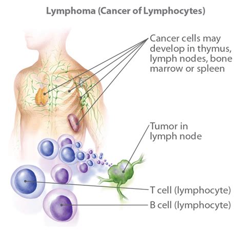 What Is Lymphoma Signs Symptoms Types Stages
