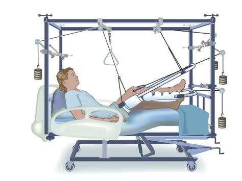 Buck traction information including symptoms, causes, diseases, symptoms, treatments, and other these medical condition or symptom topics may be relevant to medical information for buck traction Bucks Traction-Genevieve Cragoe, Brianna Hanzmann, Kenyn ...