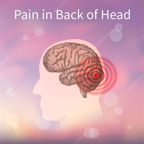 Pain In Back Of The Head Illustration Stock Image F0250122