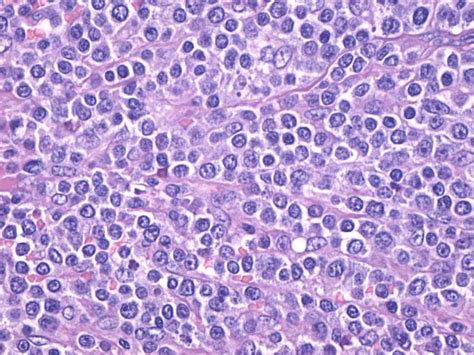 Diffuse Large B Cell Lymphoma Diffuse Proliferation Of Large Lymphoid