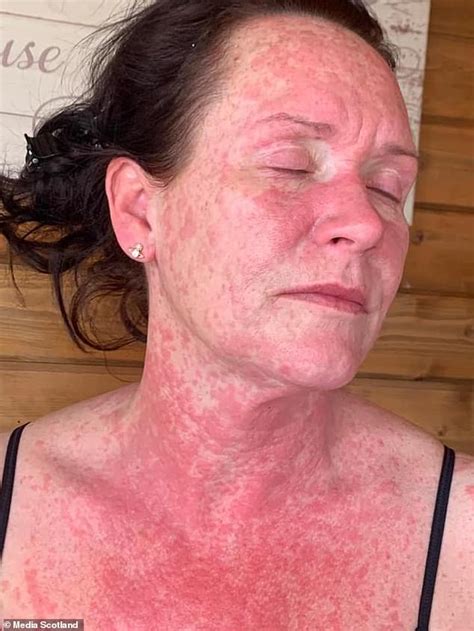 Mothers Face Arms Chest Back And Legs Erupt In Agonising Red Rash